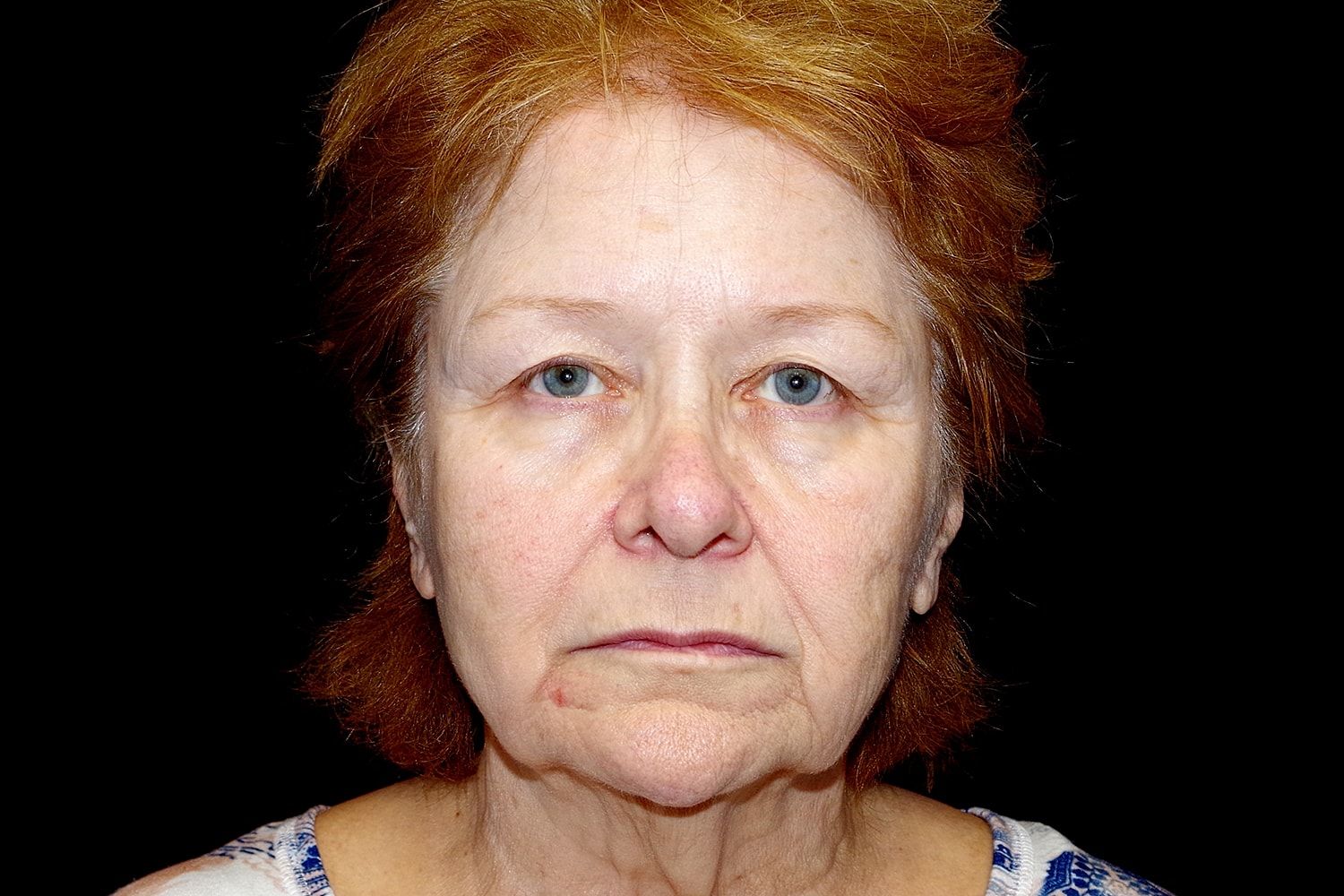 Blepharoplasty | Eyelid Lift Before & After