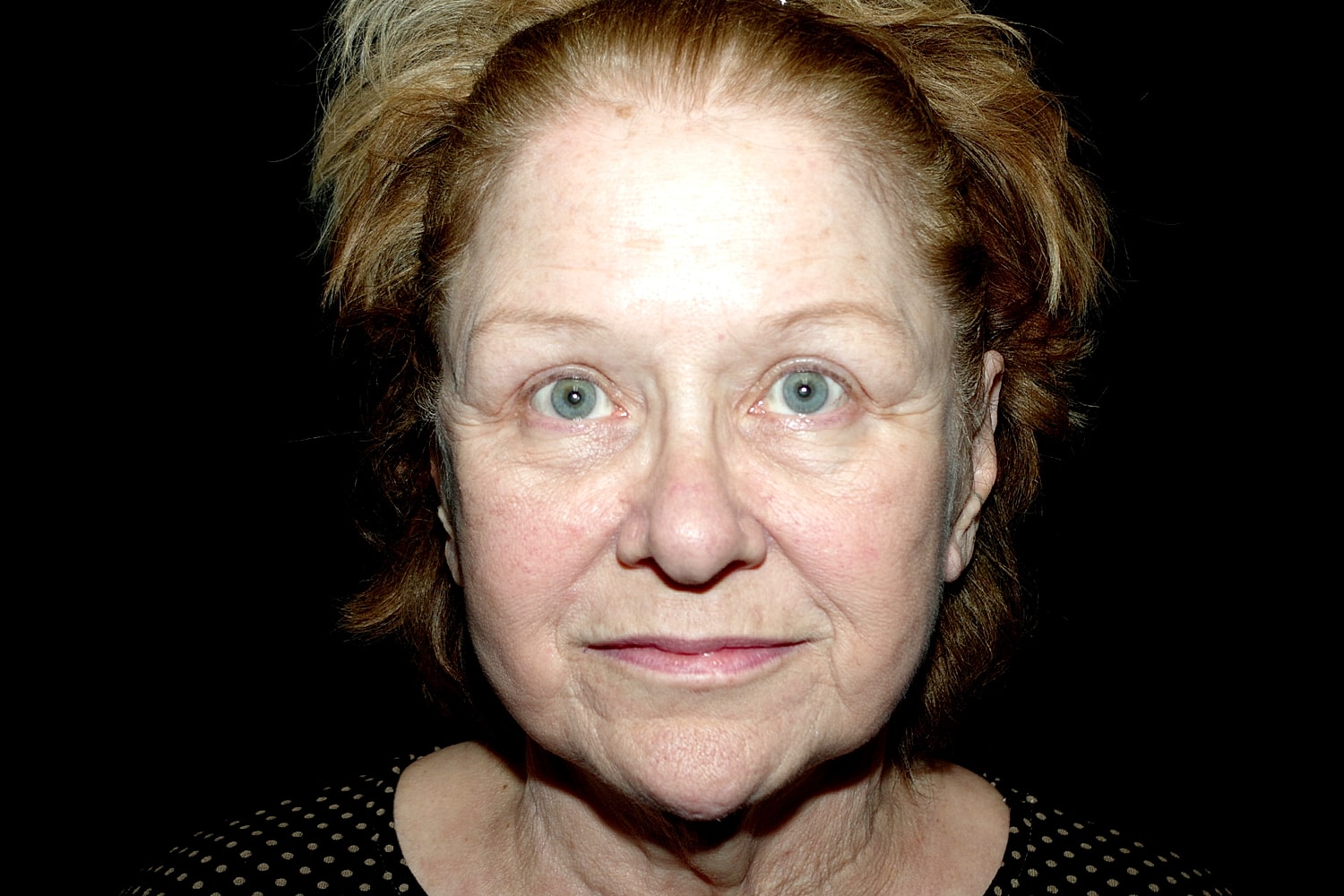 Blepharoplasty | Eyelid Lift Before & After