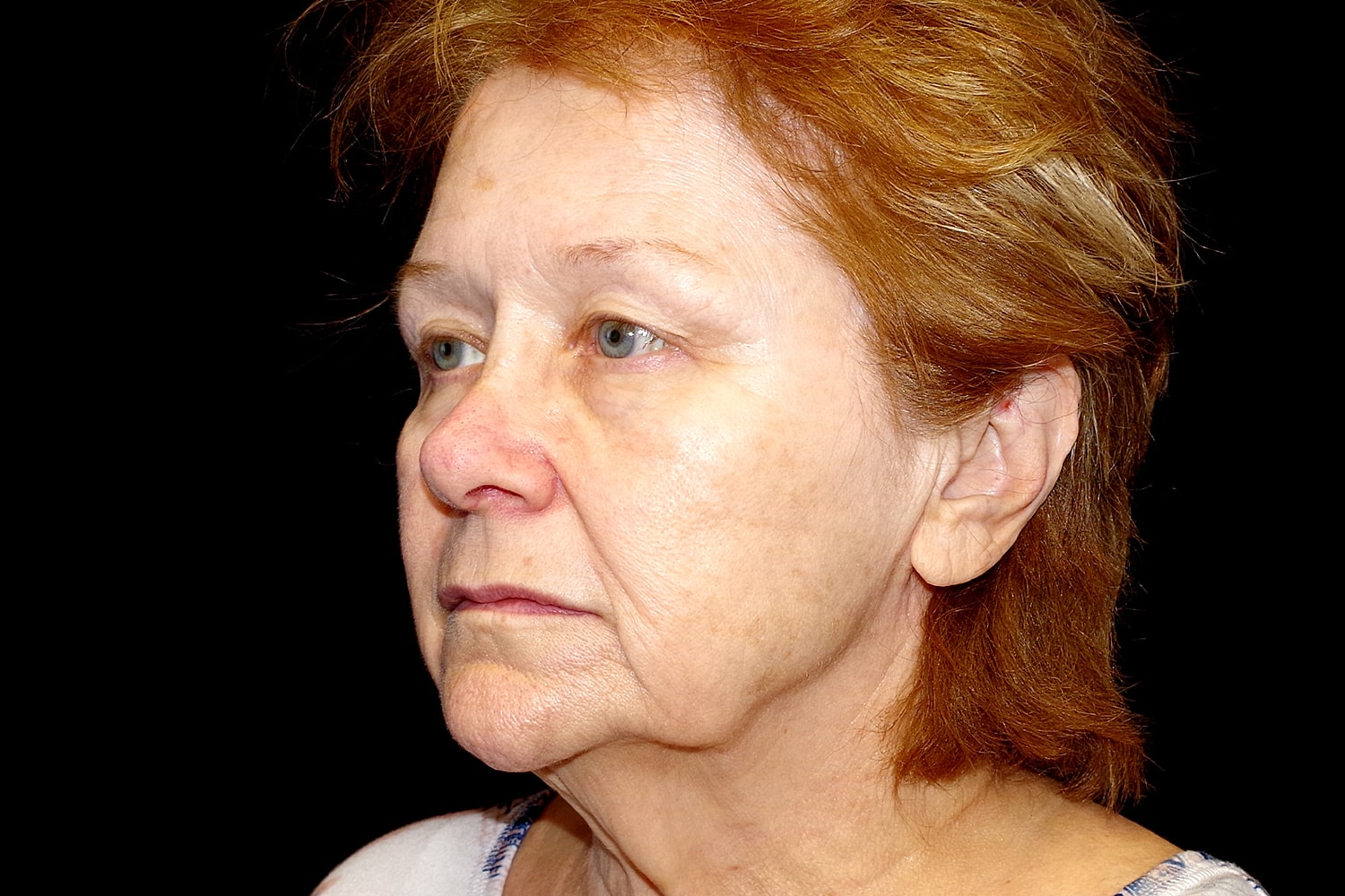 Blepharoplasty | Eyelid Lift Before & After