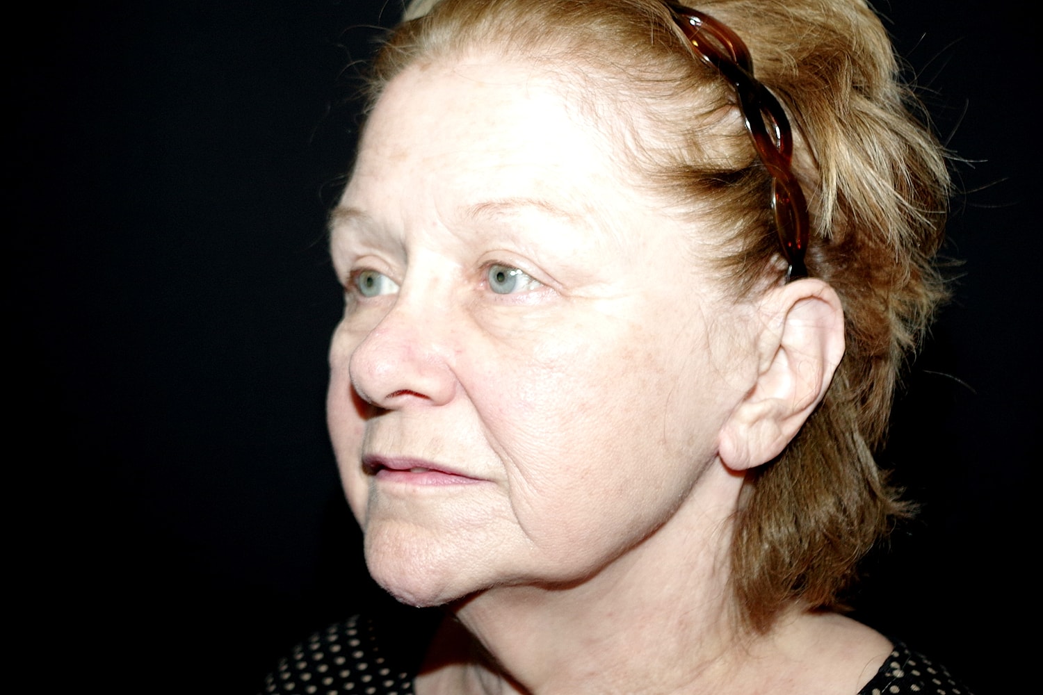 Blepharoplasty | Eyelid Lift Before & After