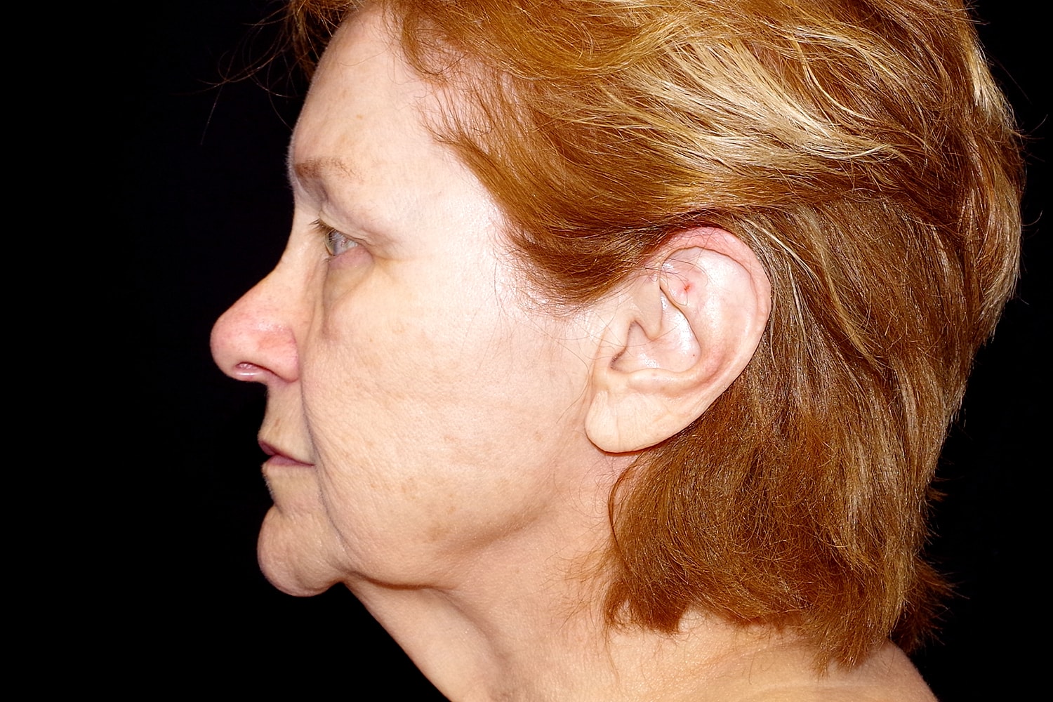 Blepharoplasty | Eyelid Lift Before & After