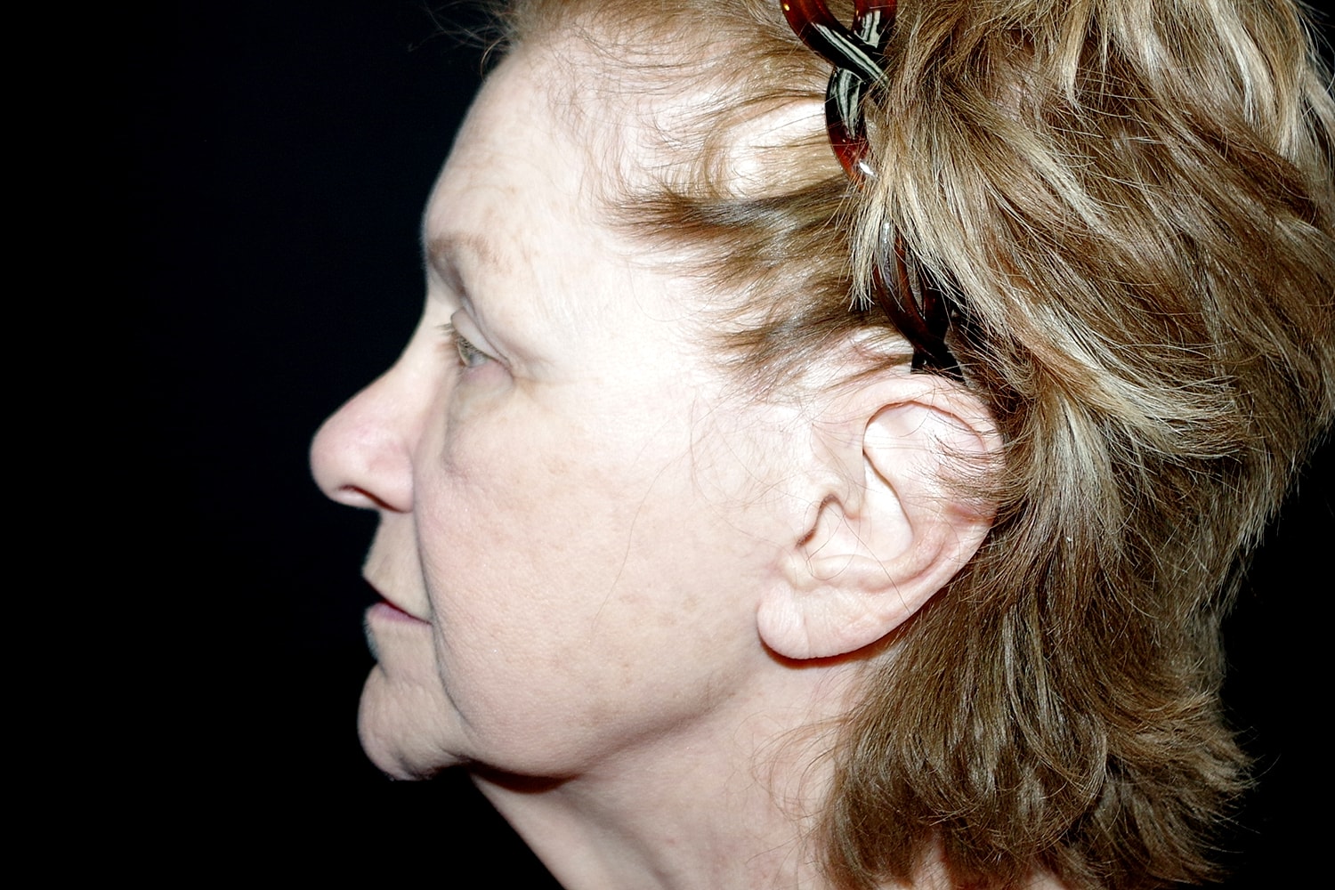 Blepharoplasty | Eyelid Lift Before & After
