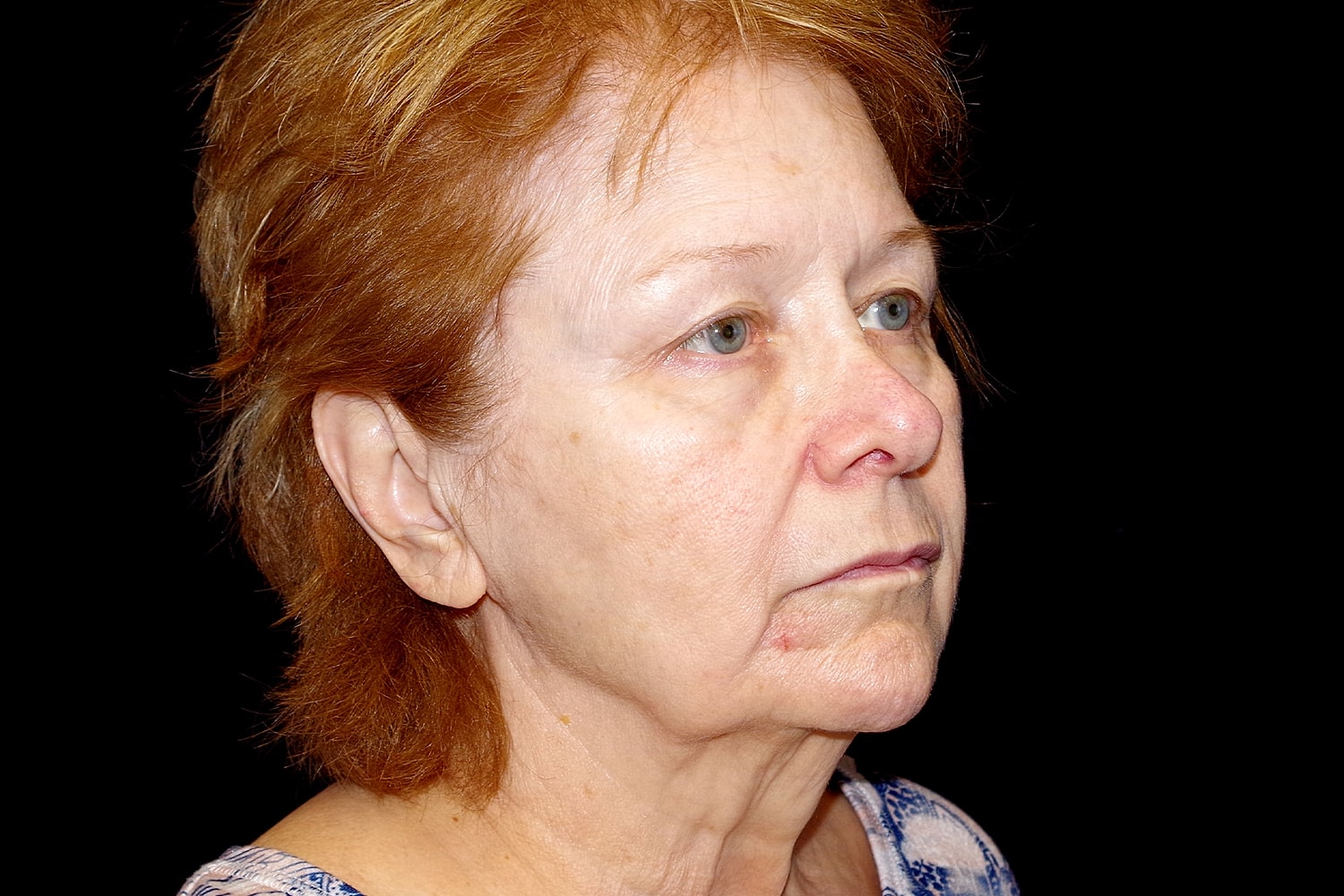 Blepharoplasty | Eyelid Lift Before & After