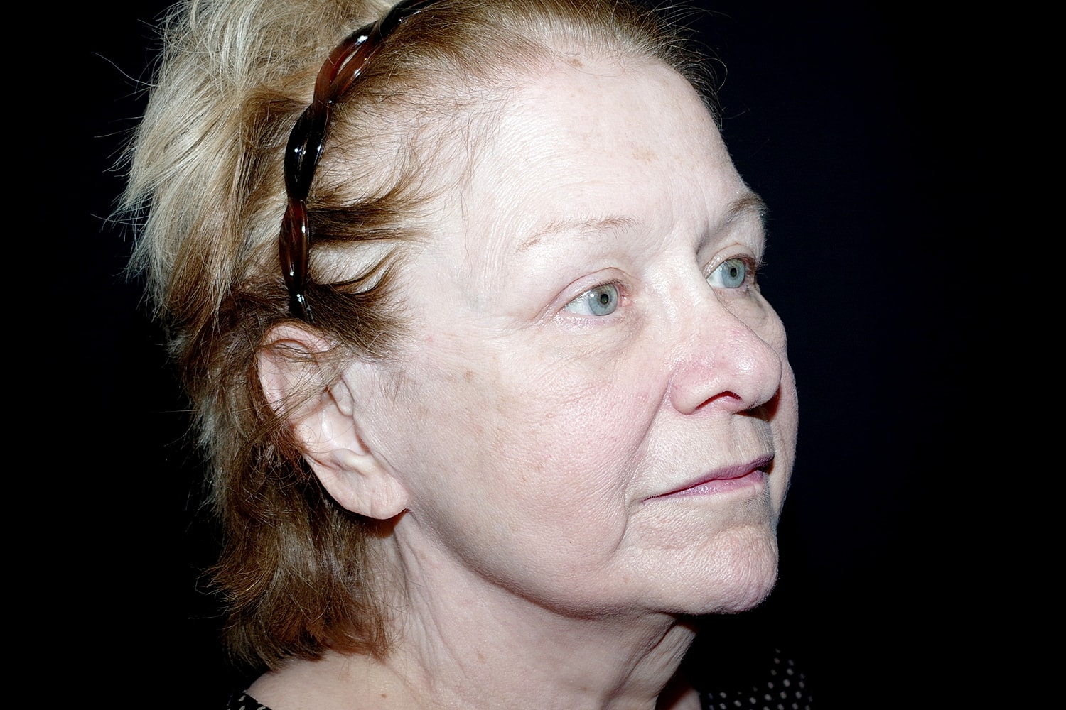 Blepharoplasty | Eyelid Lift Before & After