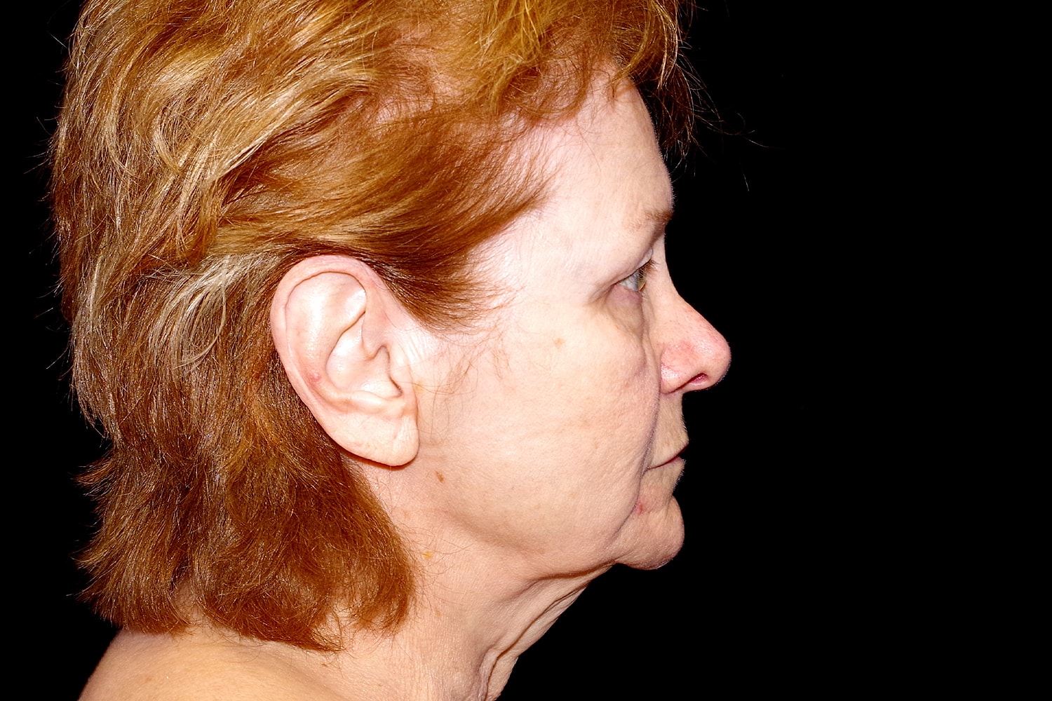 Blepharoplasty | Eyelid Lift Before & After