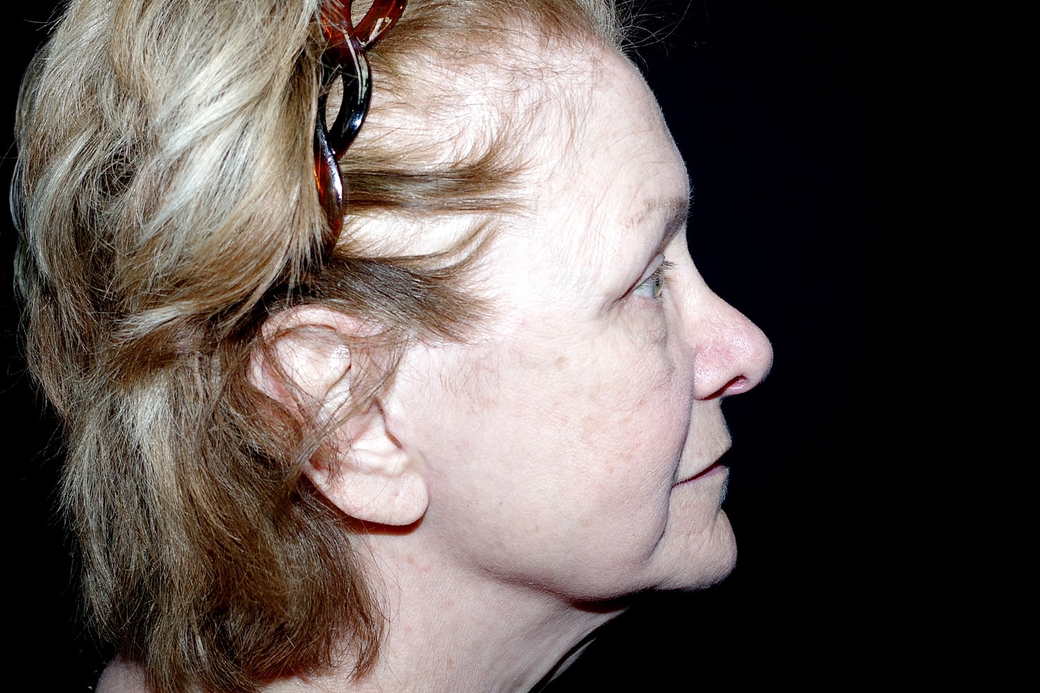Blepharoplasty | Eyelid Lift Before & After