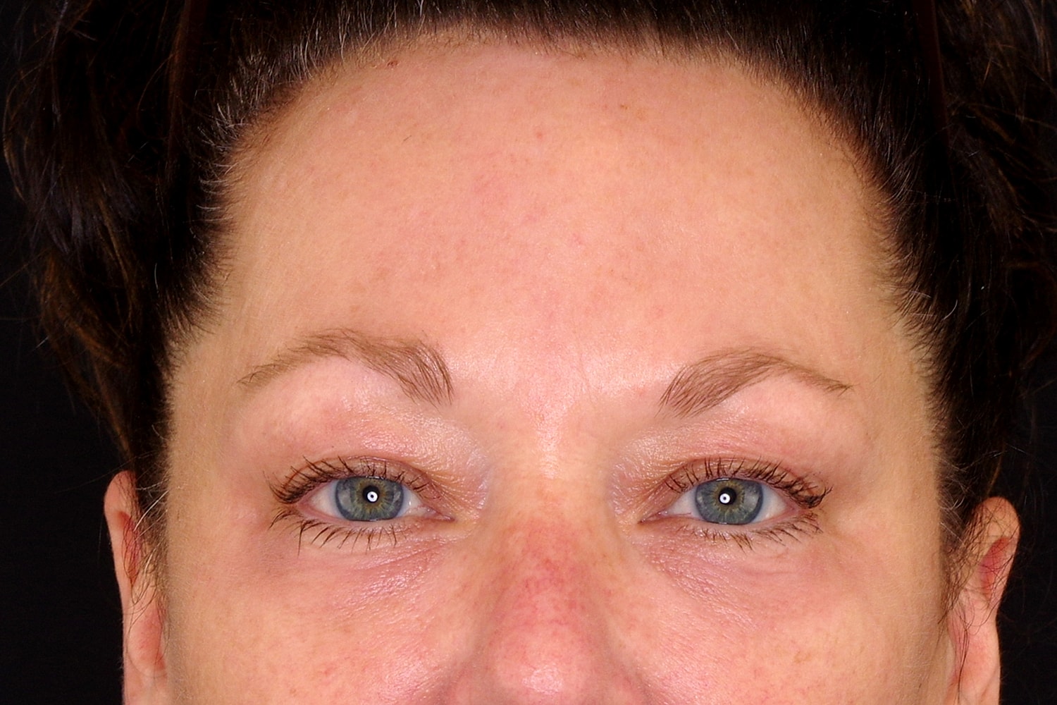 Blepharoplasty | Eyelid Lift Before & After