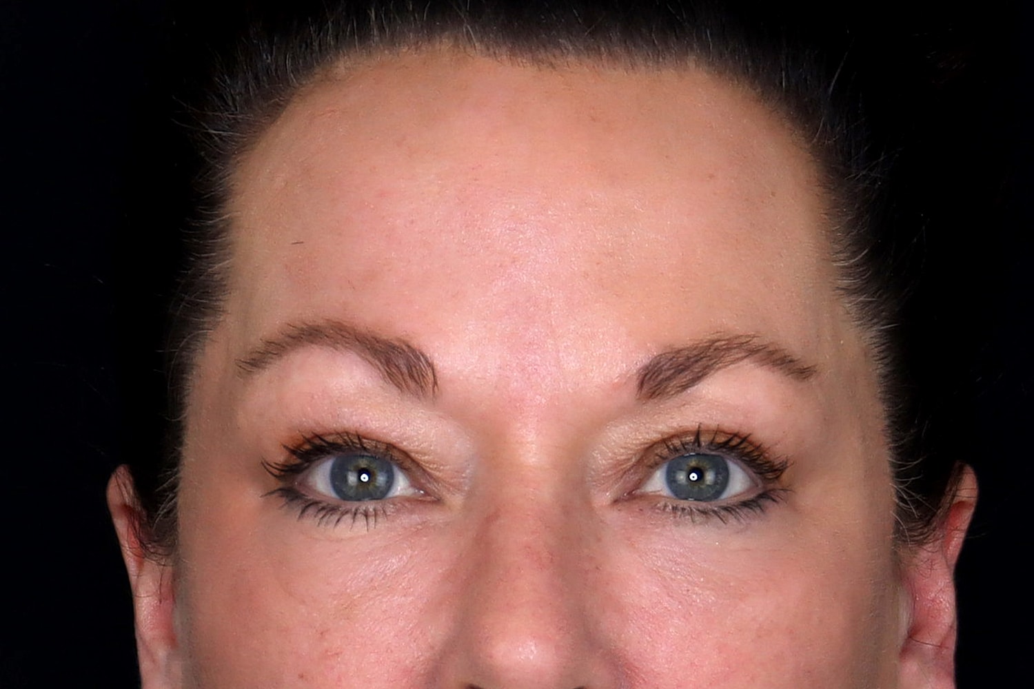 Blepharoplasty | Eyelid Lift Before & After