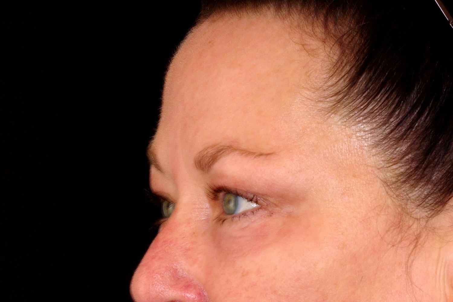 Blepharoplasty | Eyelid Lift Before & After