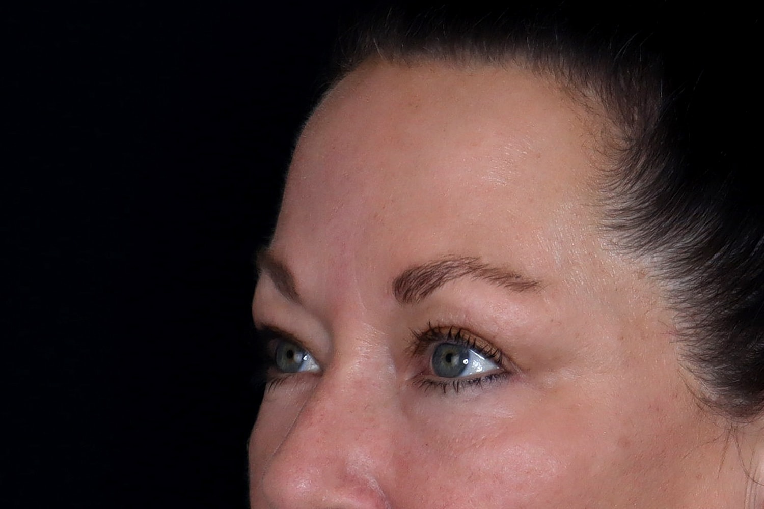 Blepharoplasty | Eyelid Lift Before & After