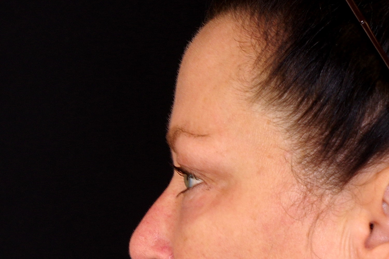 Blepharoplasty | Eyelid Lift Before & After