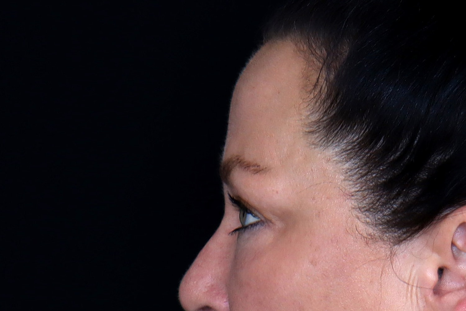 Blepharoplasty | Eyelid Lift Before & After