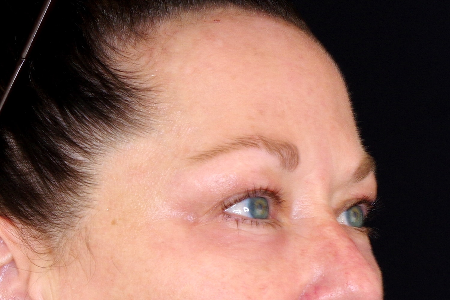 Blepharoplasty | Eyelid Lift Before & After