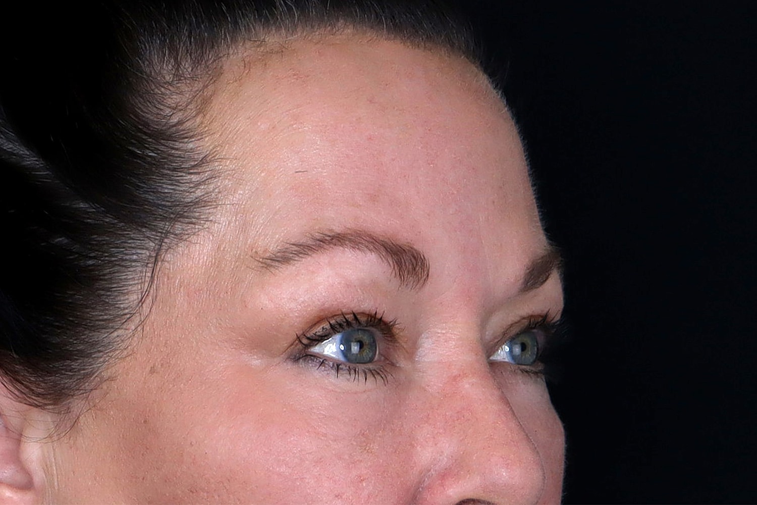Blepharoplasty | Eyelid Lift Before & After