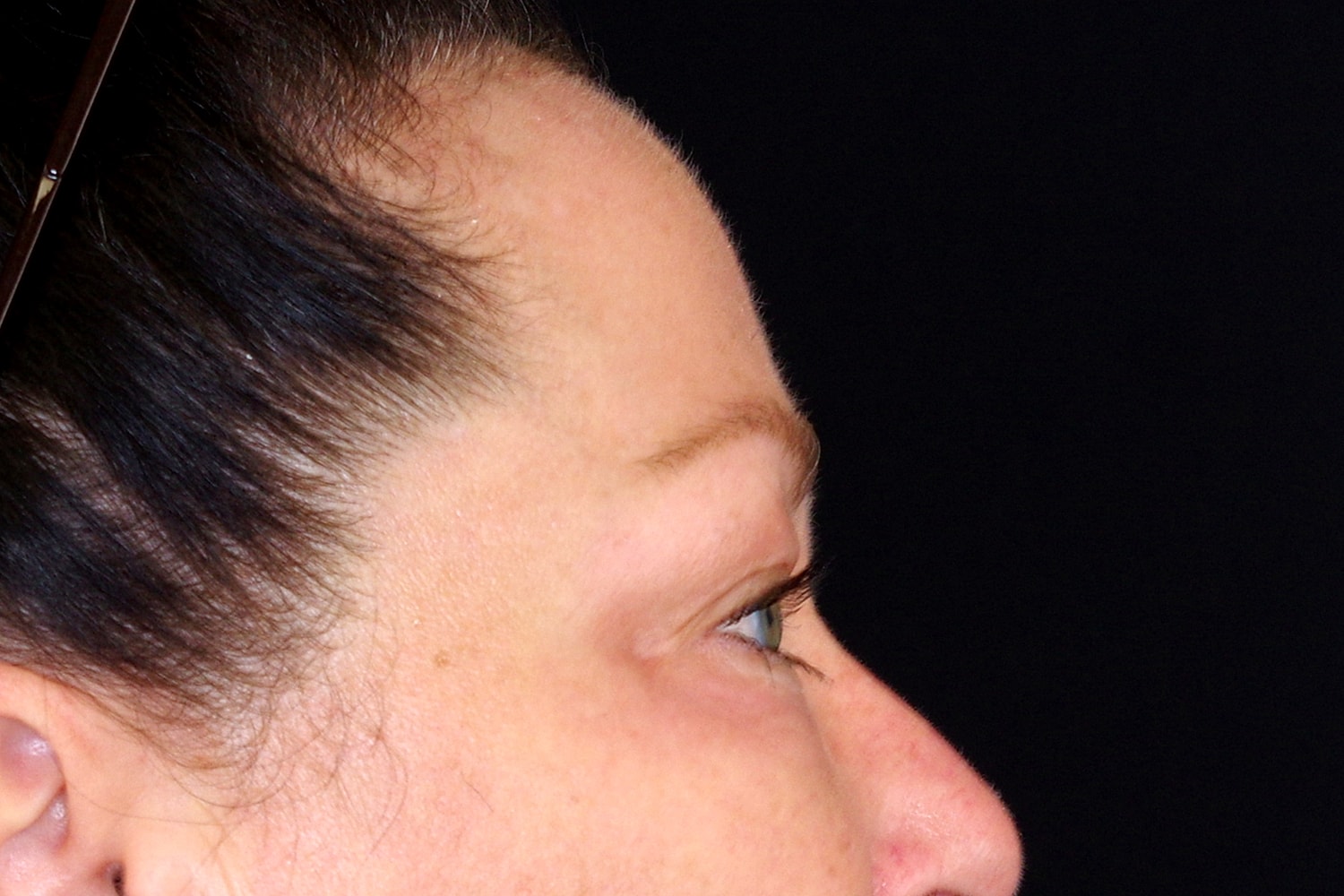 Blepharoplasty | Eyelid Lift Before & After