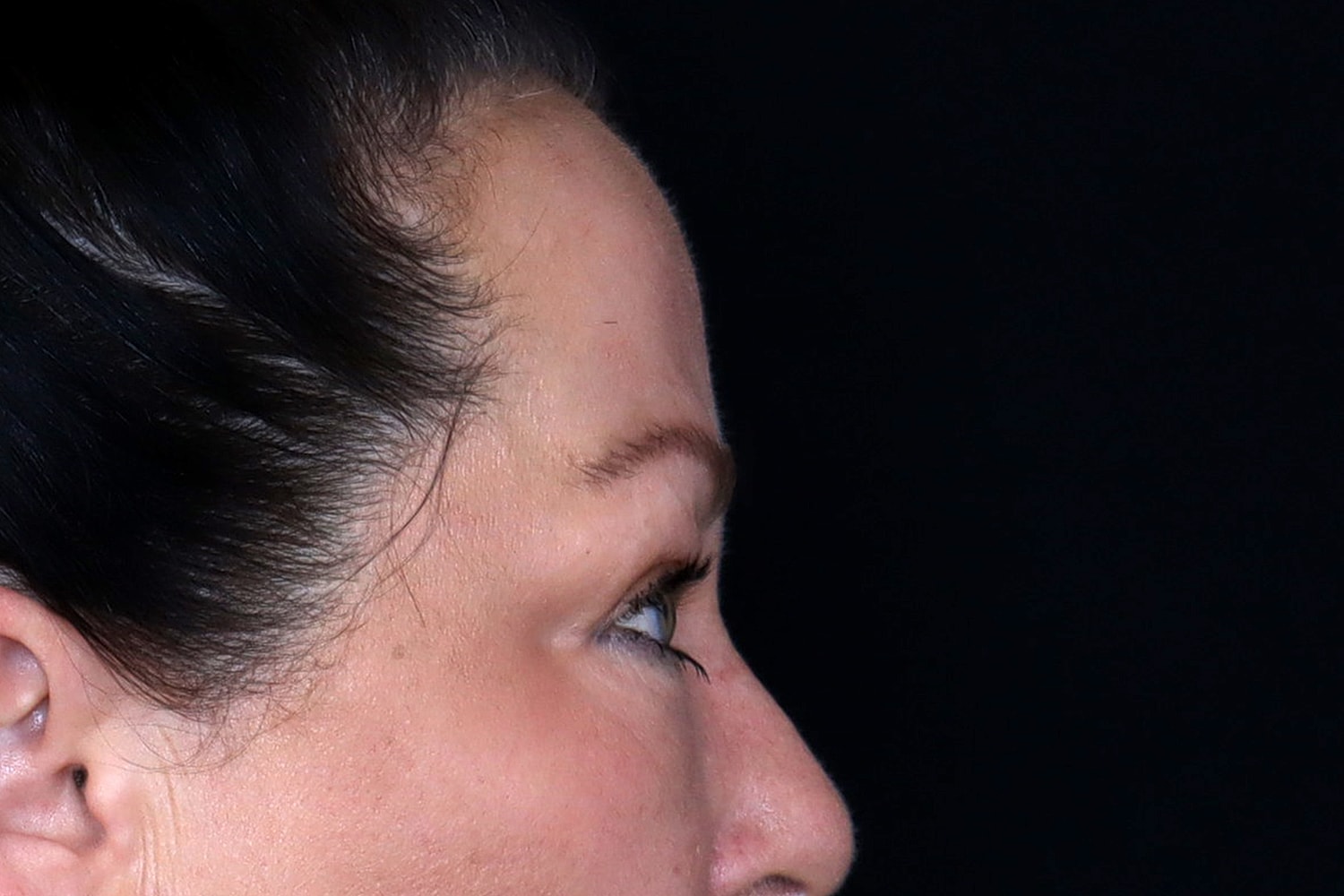 Blepharoplasty | Eyelid Lift Before & After