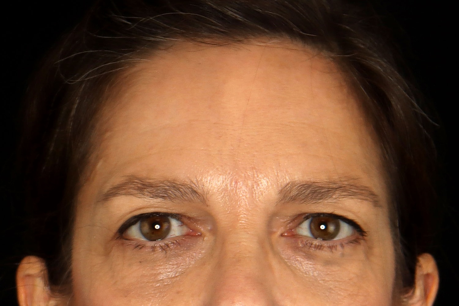 Blepharoplasty | Eyelid Lift Before & After