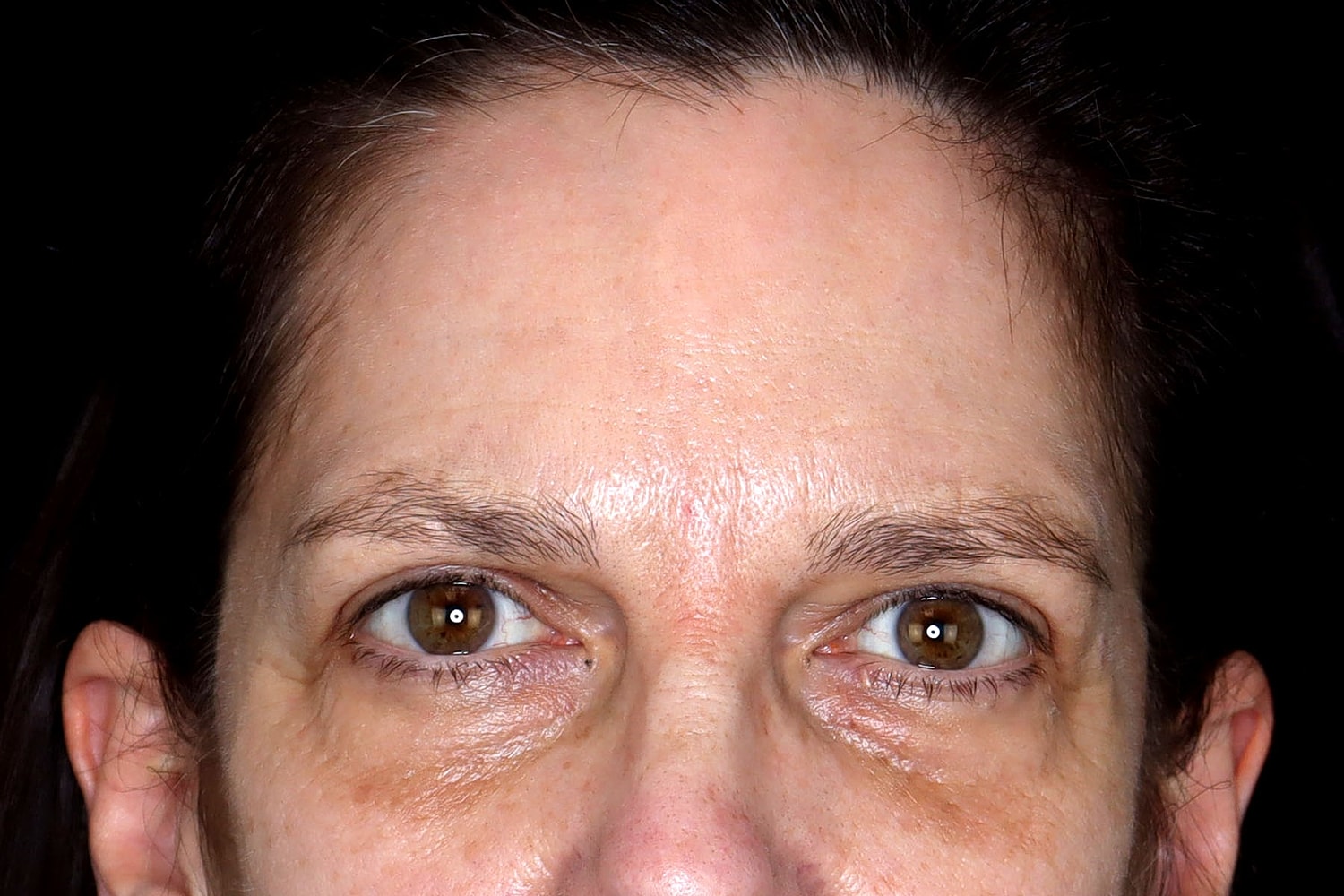 Blepharoplasty | Eyelid Lift Before & After