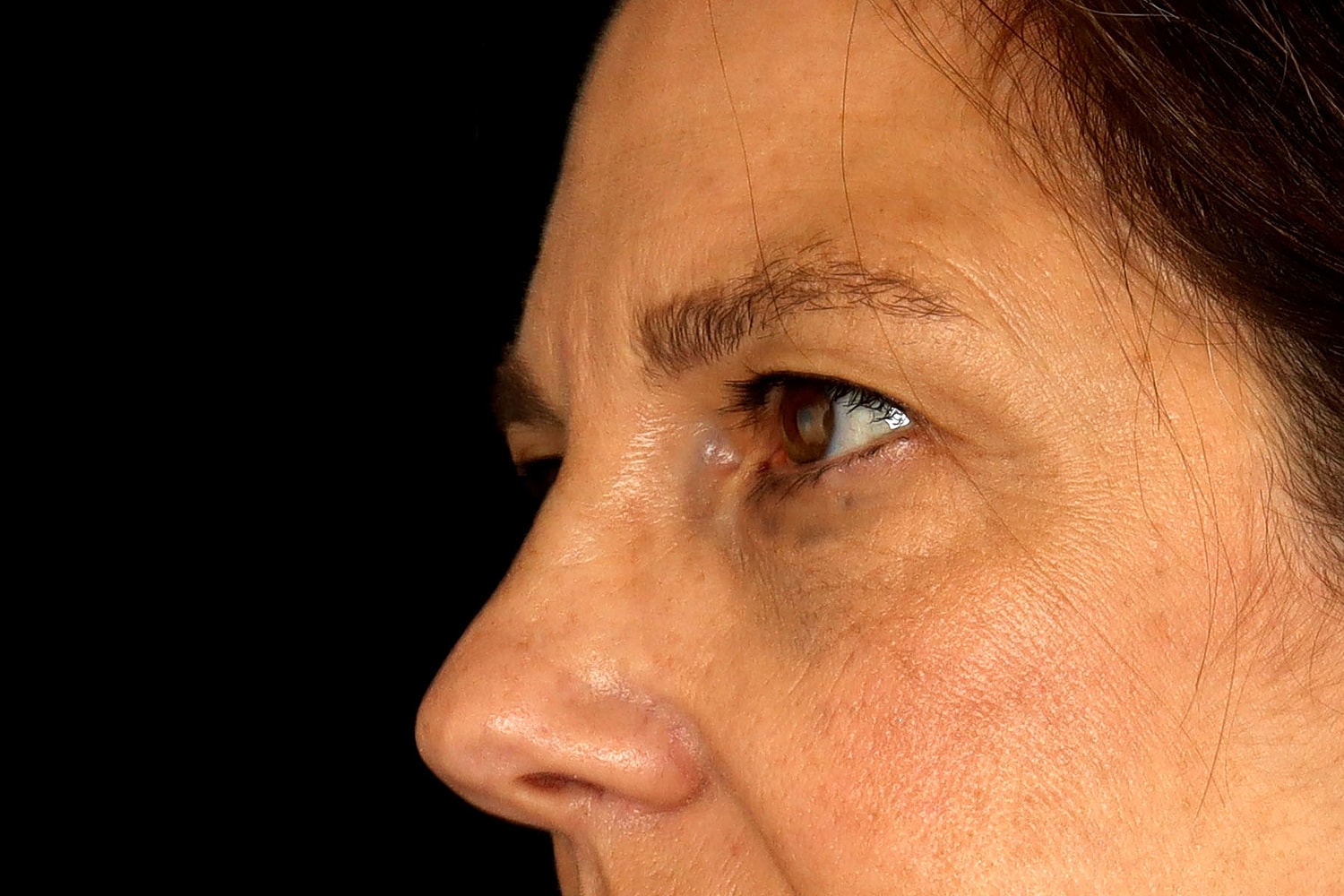 Blepharoplasty | Eyelid Lift Before & After