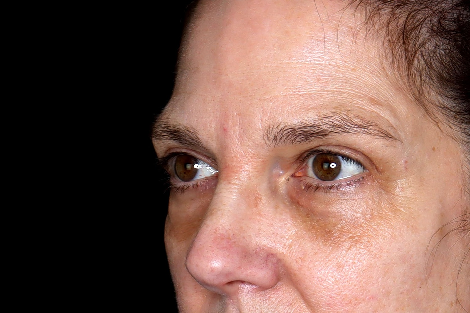 Blepharoplasty | Eyelid Lift Before & After