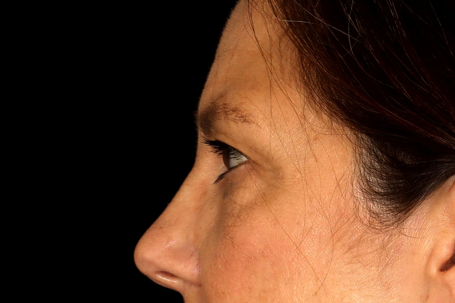 Blepharoplasty | Eyelid Lift Before & After