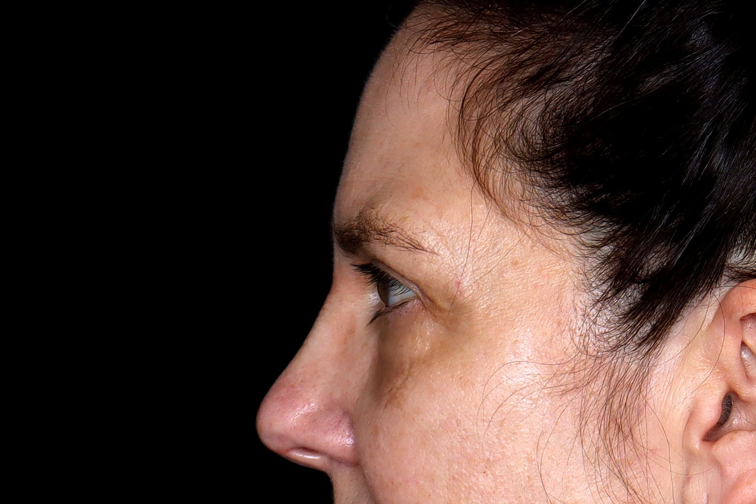 Blepharoplasty | Eyelid Lift Before & After