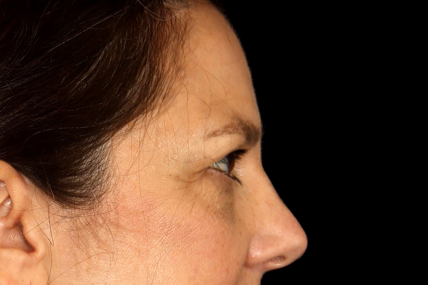 Blepharoplasty | Eyelid Lift Before & After