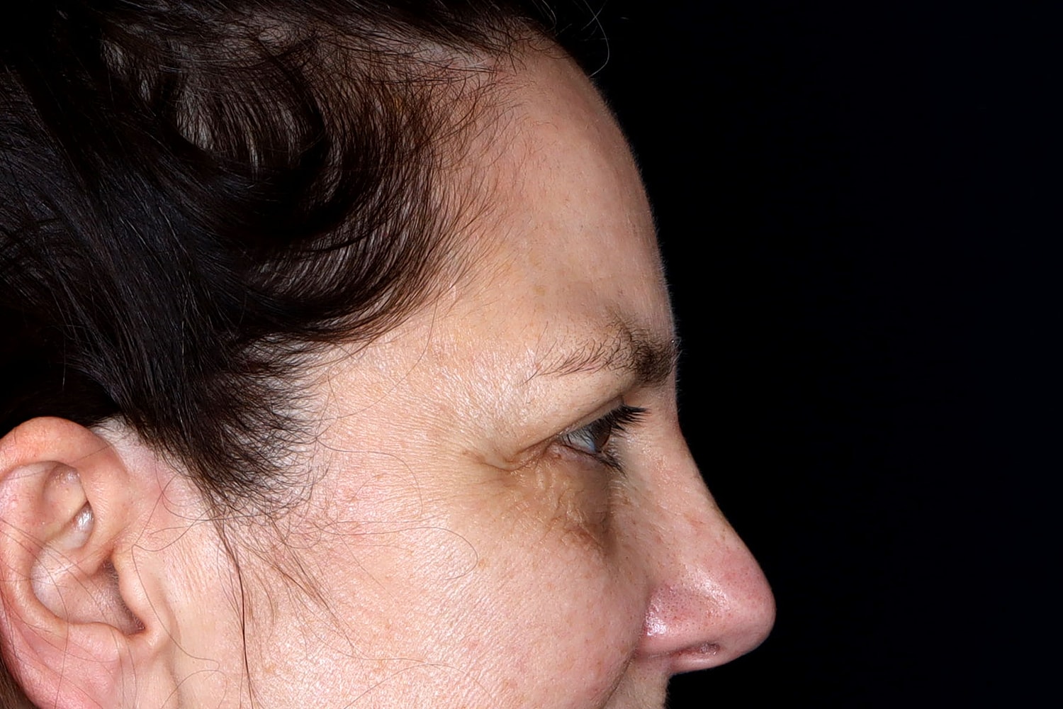 Blepharoplasty | Eyelid Lift Before & After