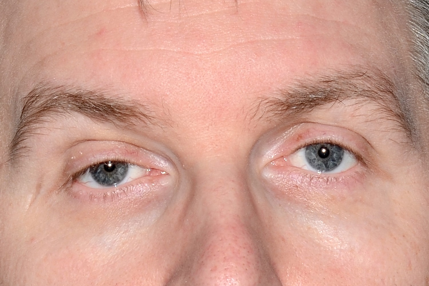Blepharoplasty | Eyelid Lift Before & After