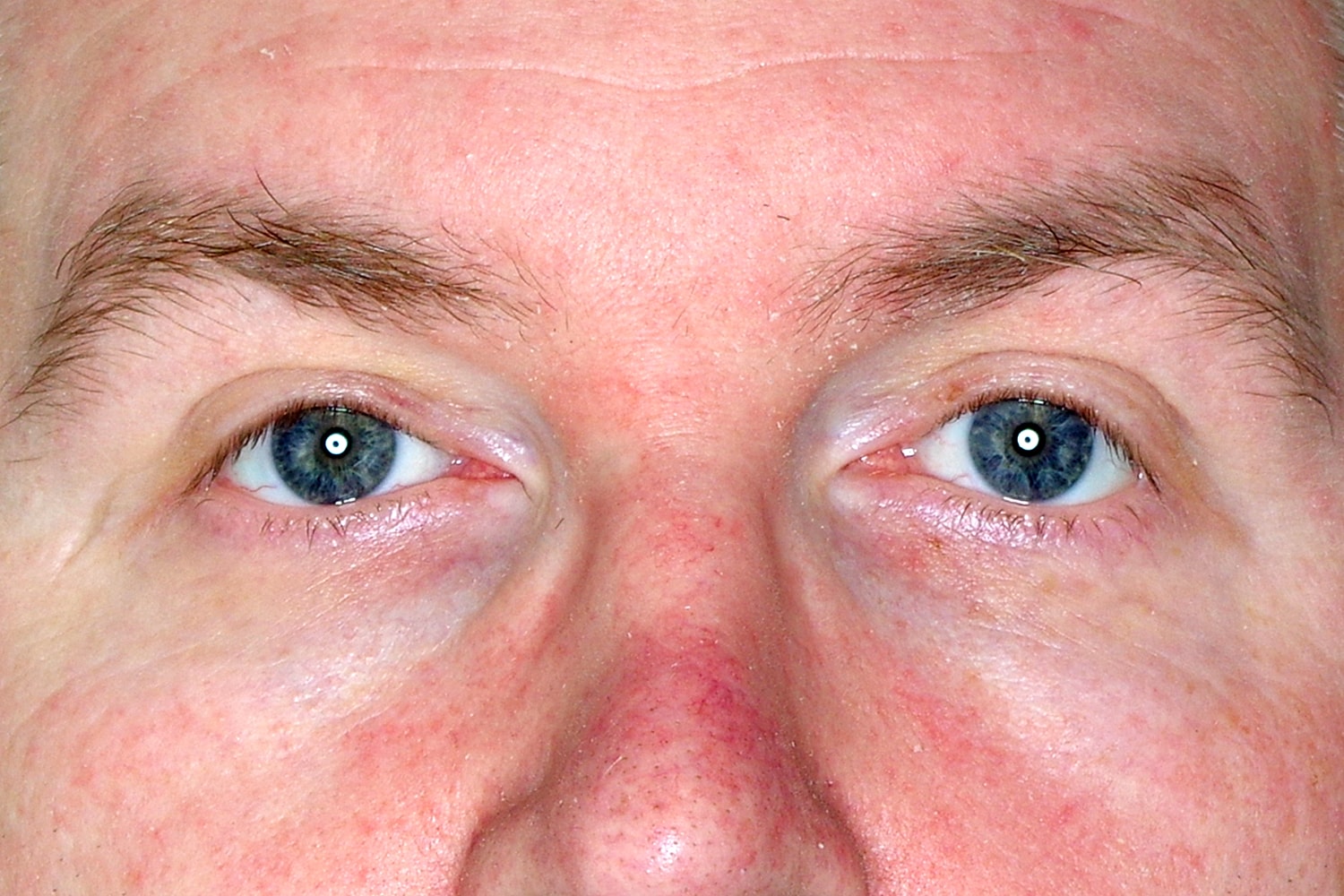 Blepharoplasty | Eyelid Lift Before & After