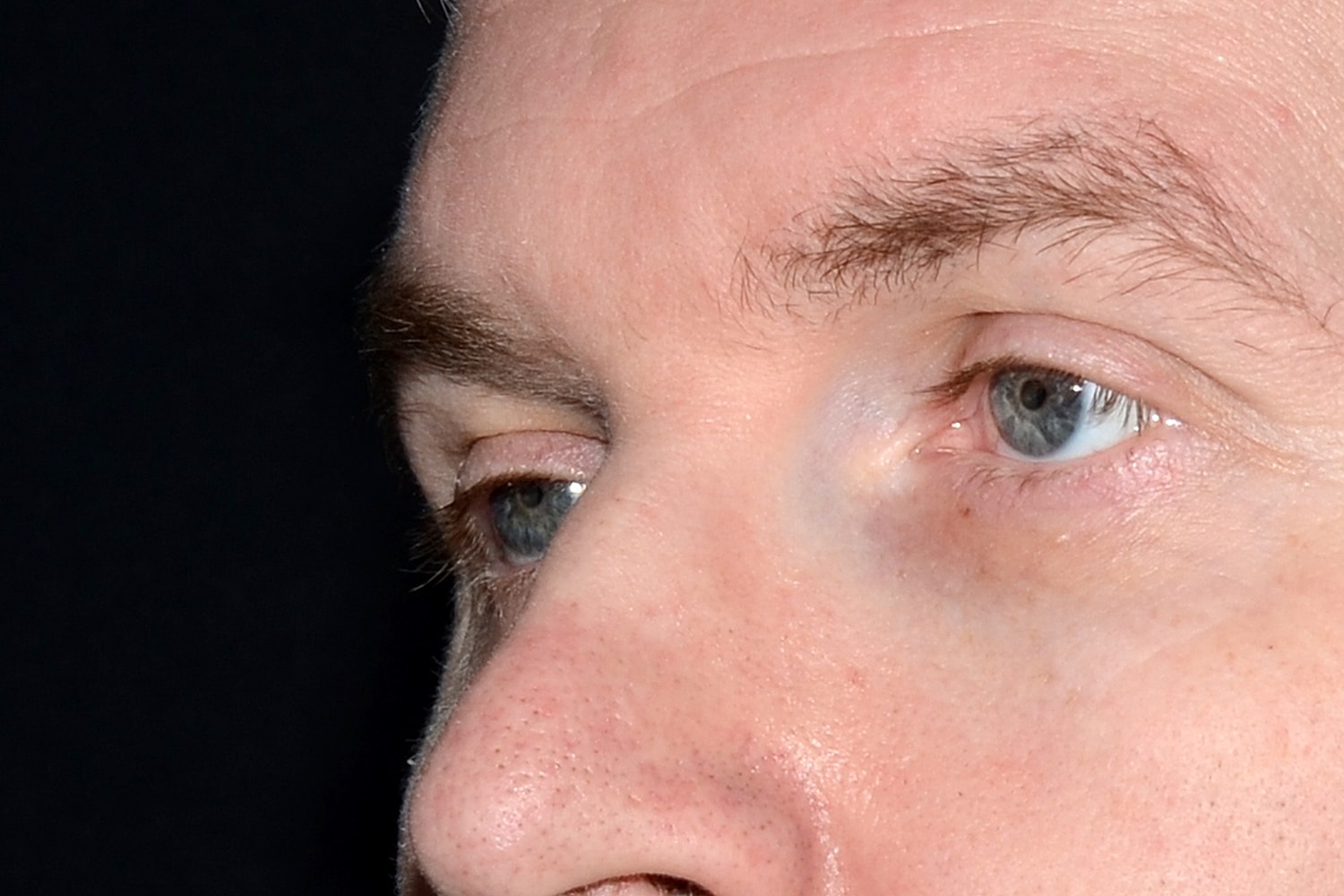 Blepharoplasty | Eyelid Lift Before & After