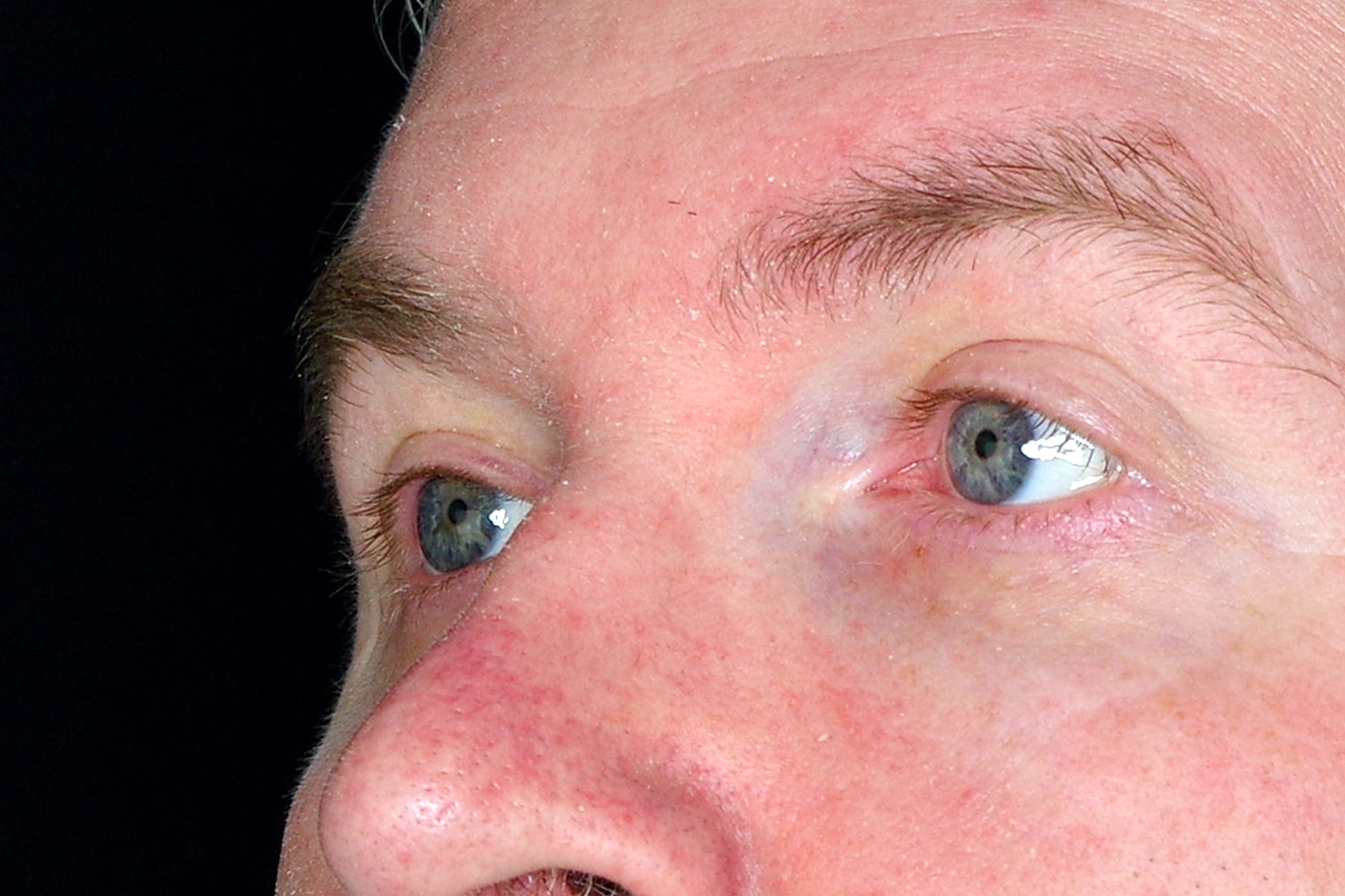 Blepharoplasty | Eyelid Lift Before & After
