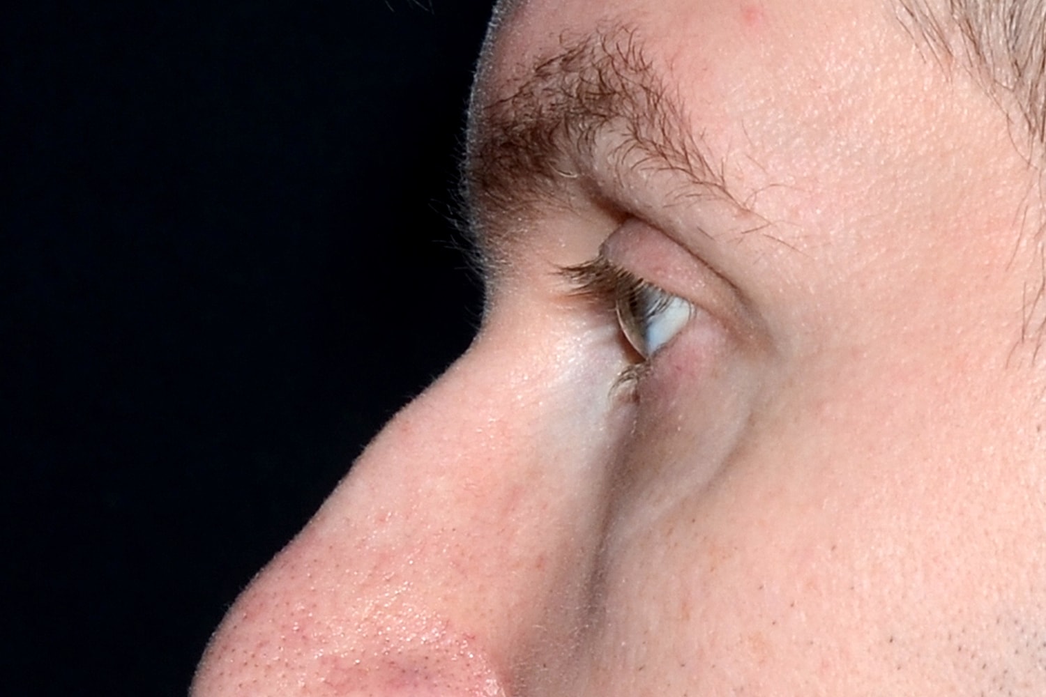 Blepharoplasty | Eyelid Lift Before & After