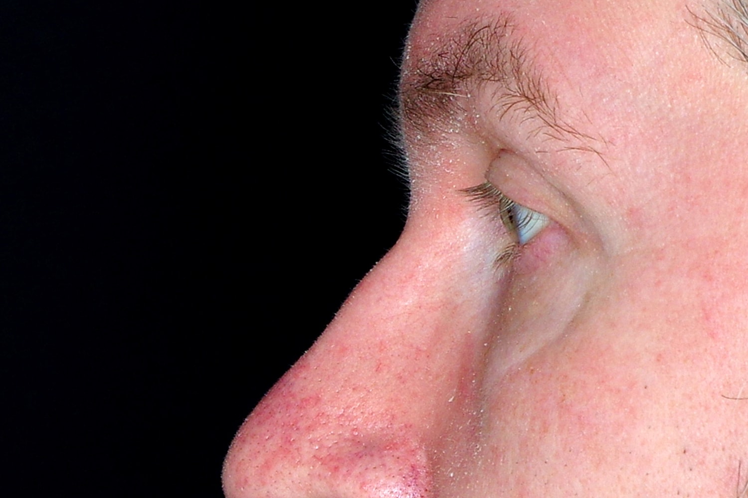 Blepharoplasty | Eyelid Lift Before & After