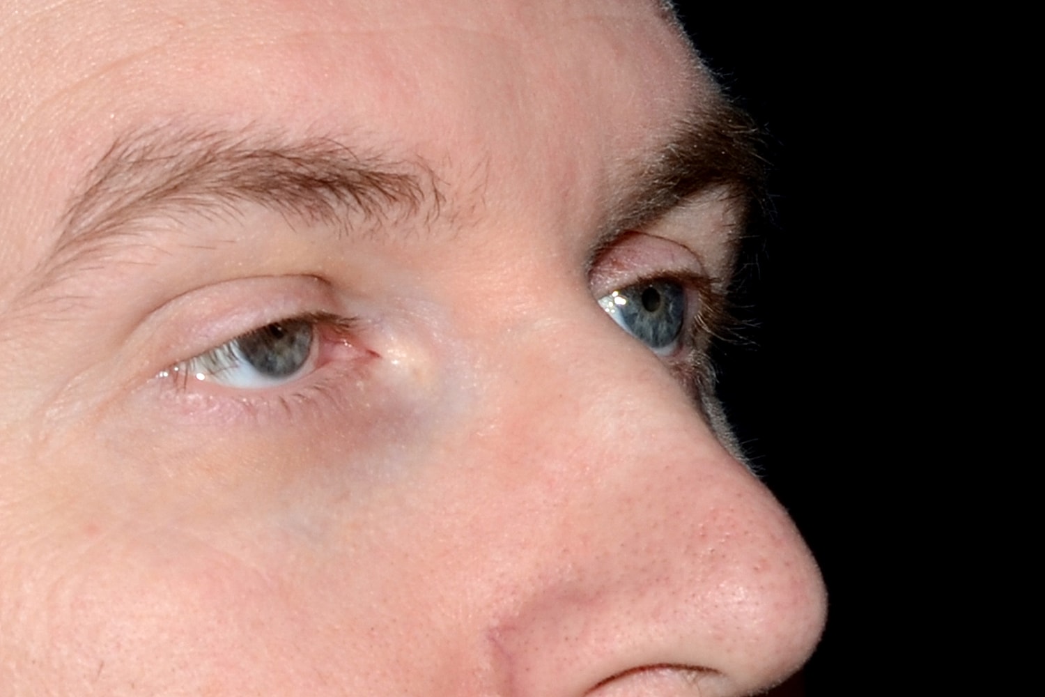 Blepharoplasty | Eyelid Lift Before & After