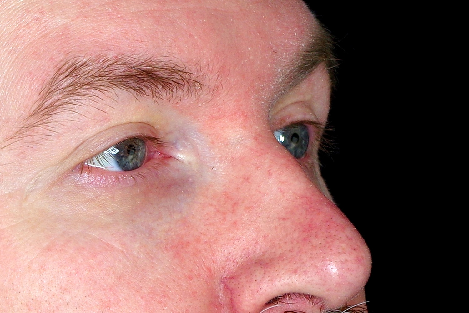 Blepharoplasty | Eyelid Lift Before & After