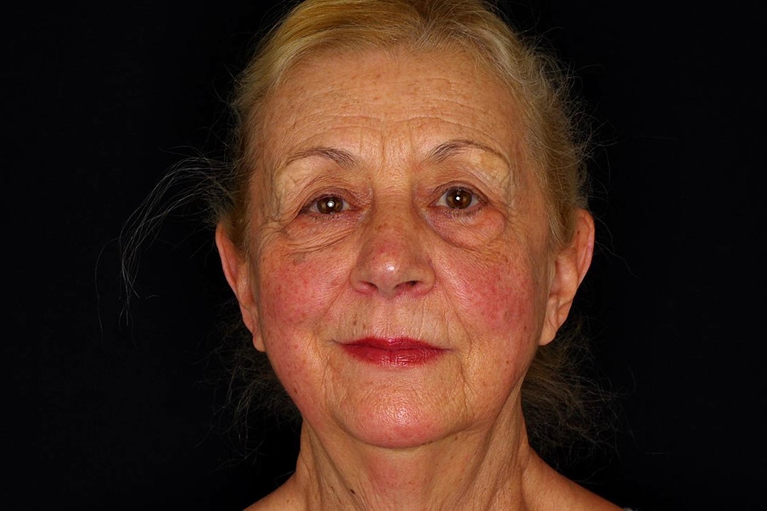 Blepharoplasty | Eyelid Lift Before & After