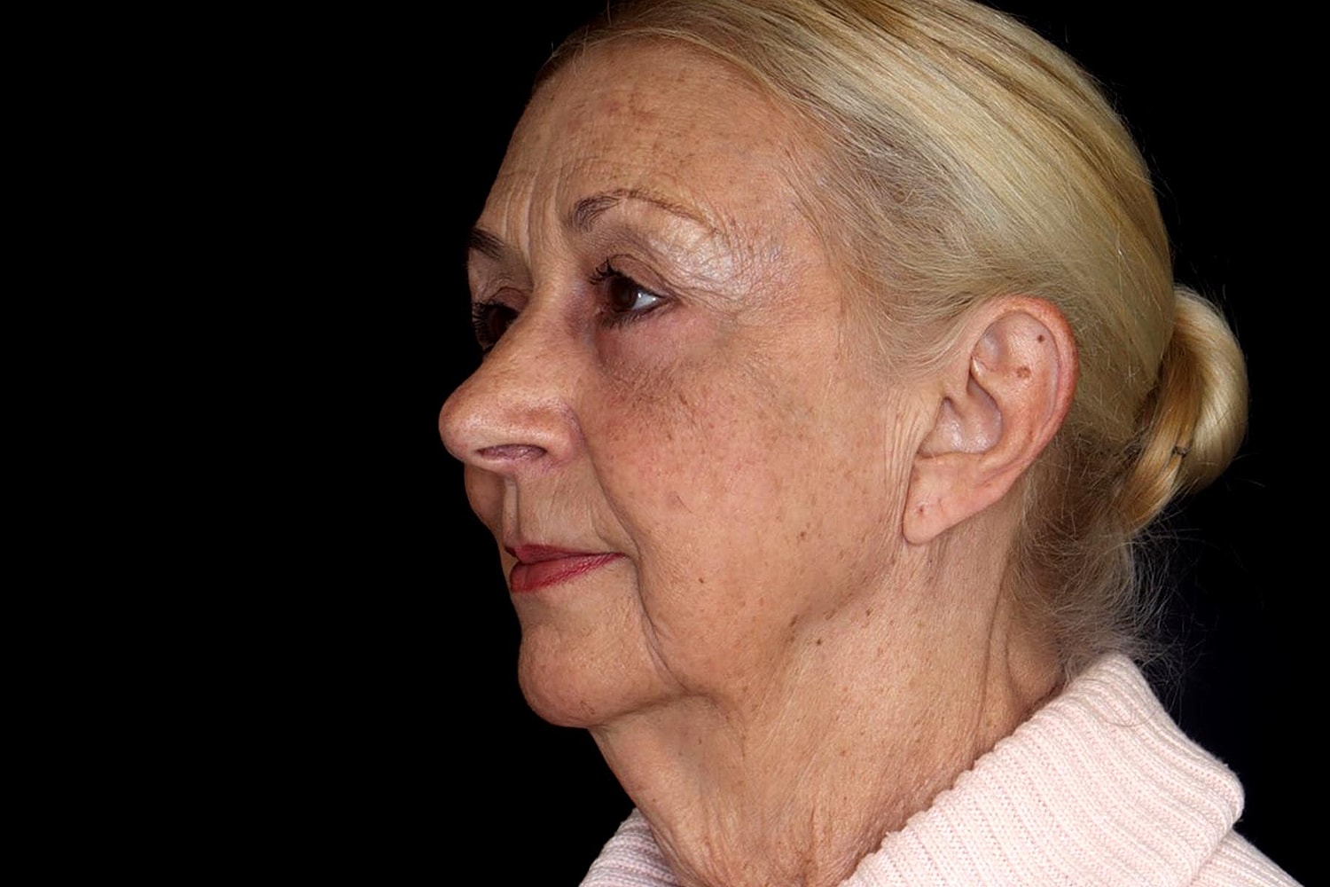 Blepharoplasty | Eyelid Lift Before & After