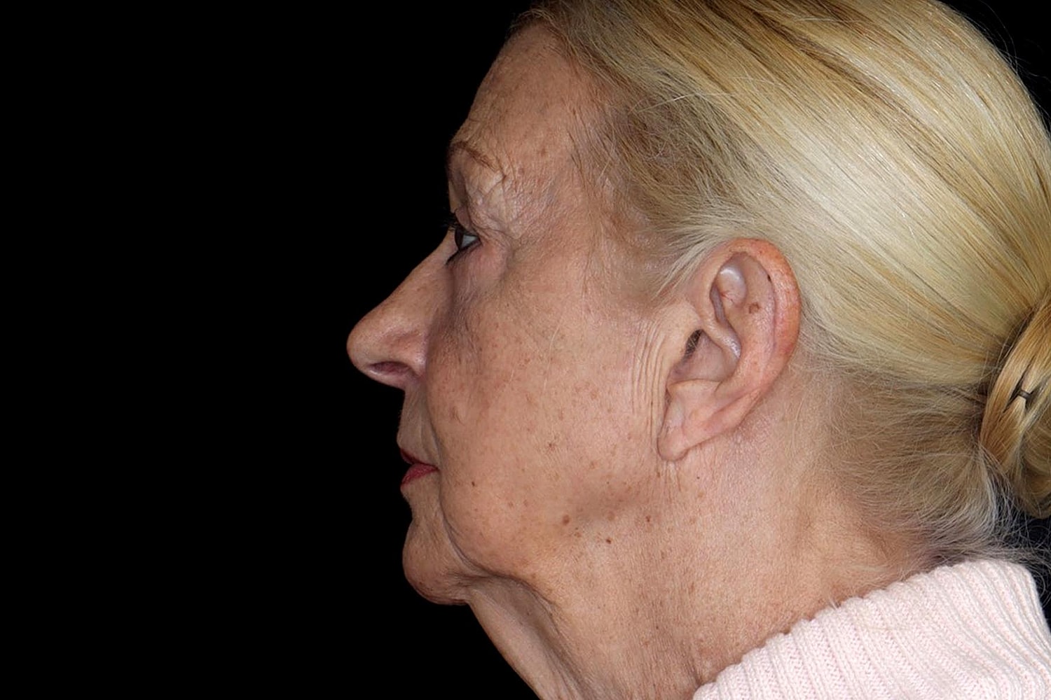 Blepharoplasty | Eyelid Lift Before & After