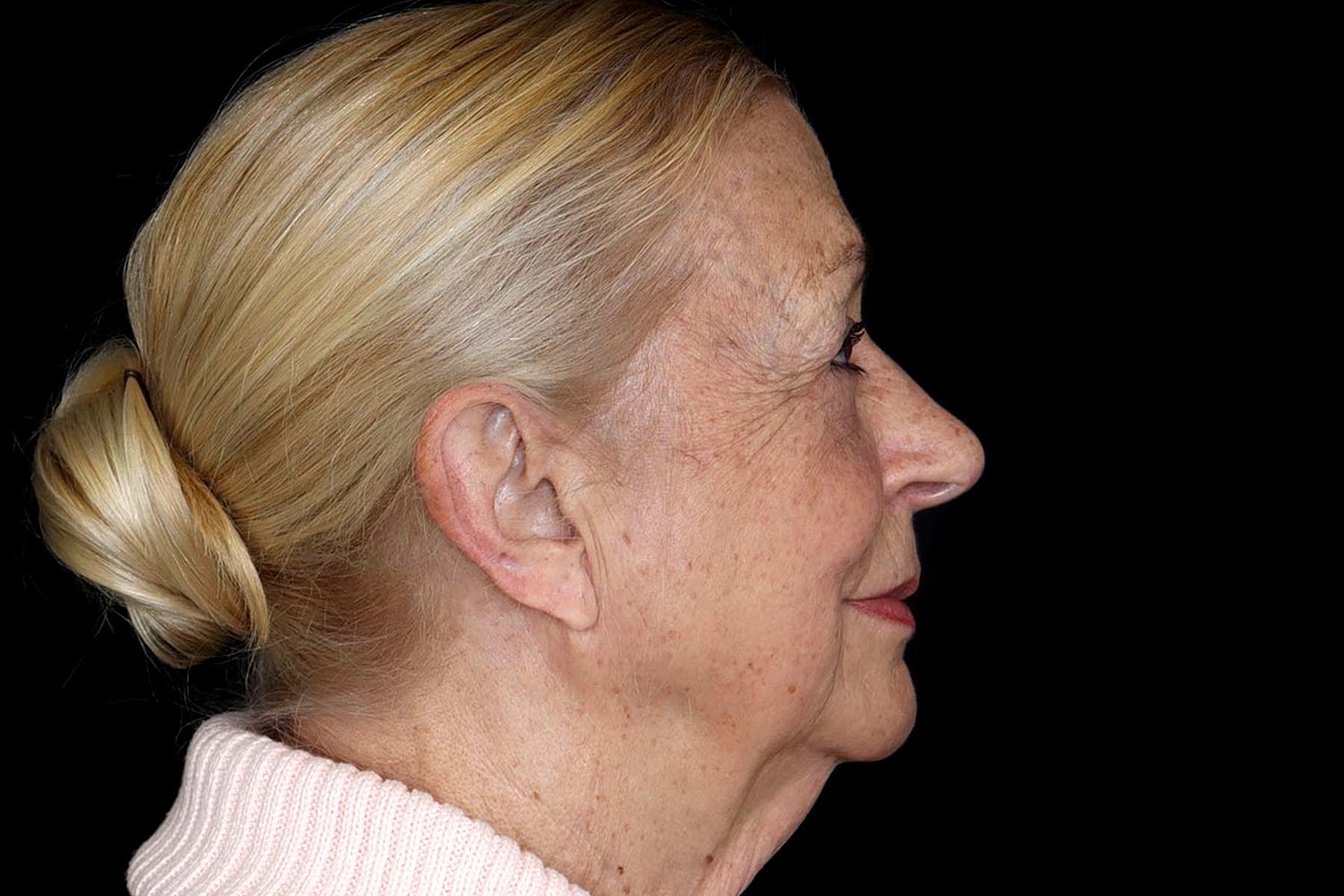 Blepharoplasty | Eyelid Lift Before & After