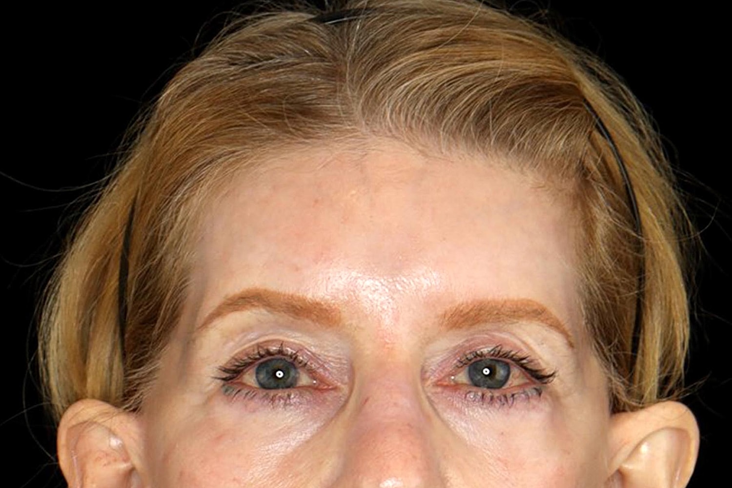 Blepharoplasty | Eyelid Lift Before & After