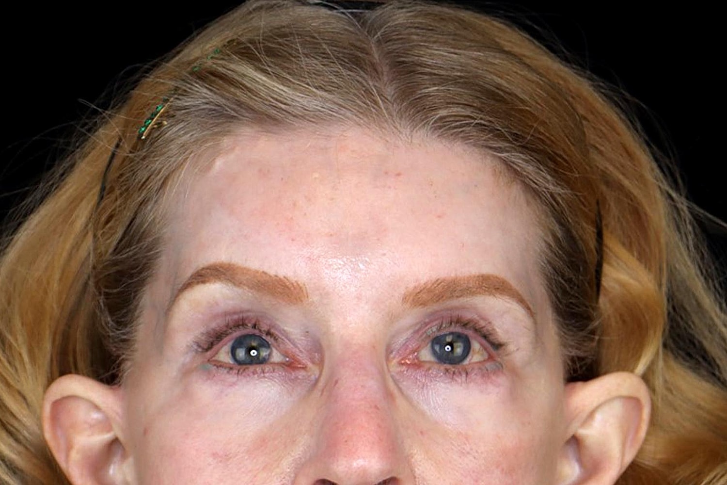 Blepharoplasty | Eyelid Lift Before & After