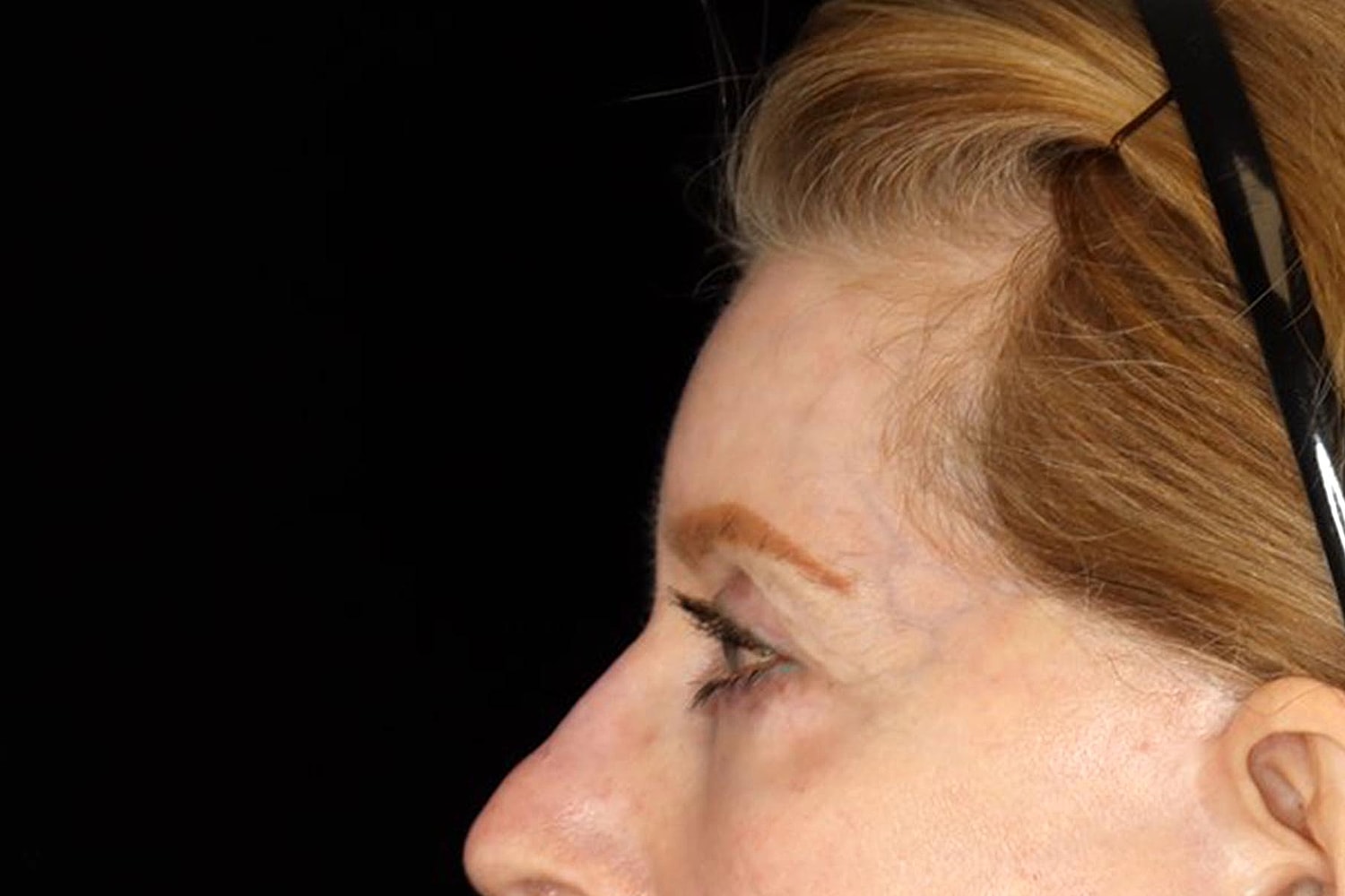 Blepharoplasty | Eyelid Lift Before & After