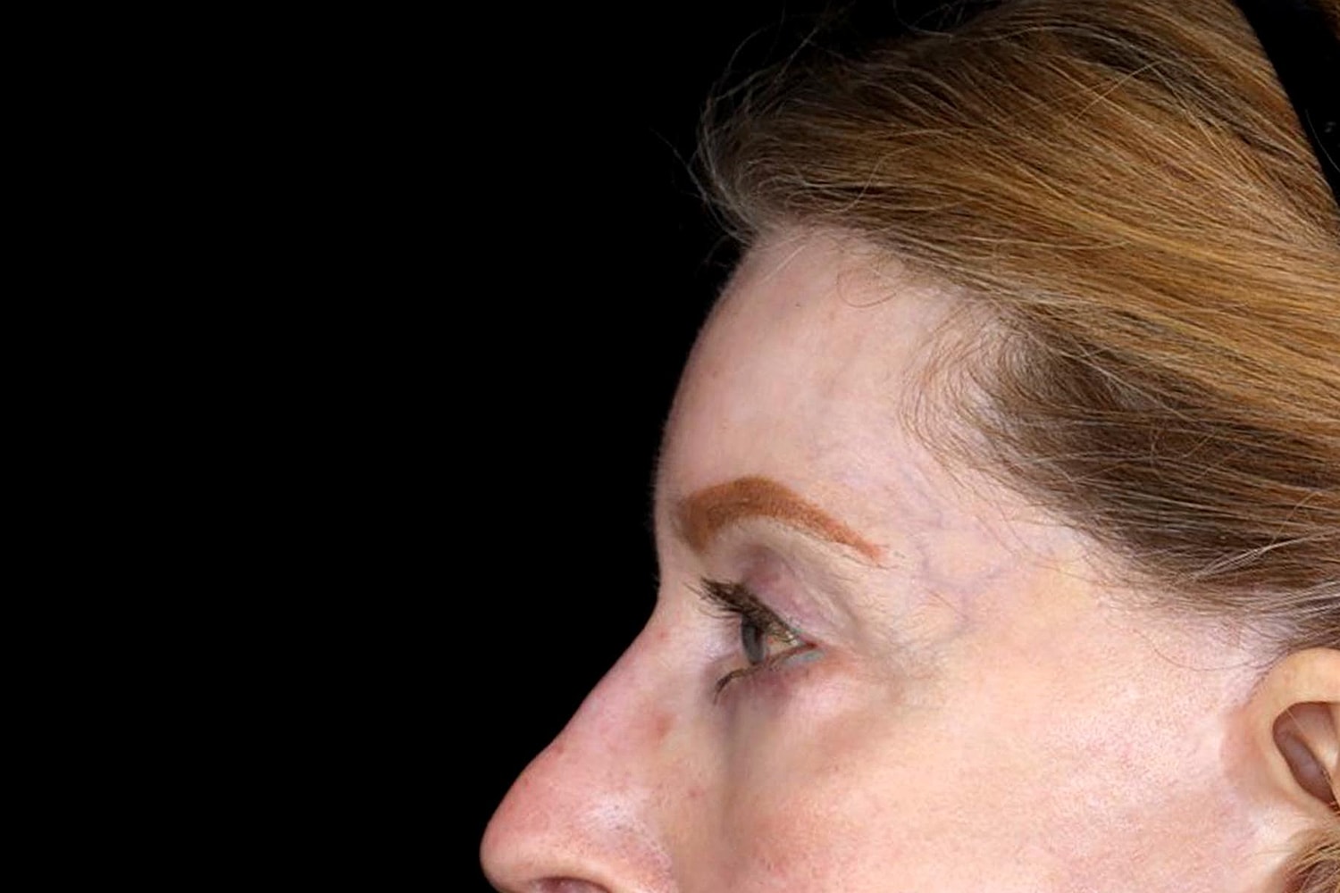 Blepharoplasty | Eyelid Lift Before & After