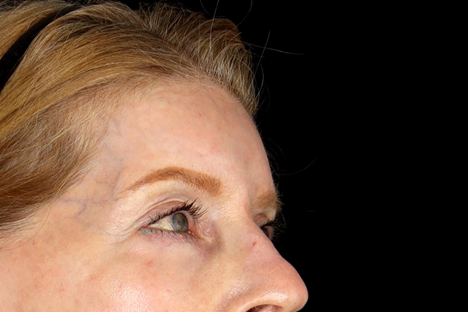 Blepharoplasty | Eyelid Lift Before & After