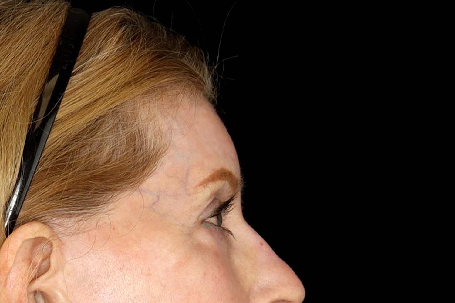 Blepharoplasty | Eyelid Lift Before & After