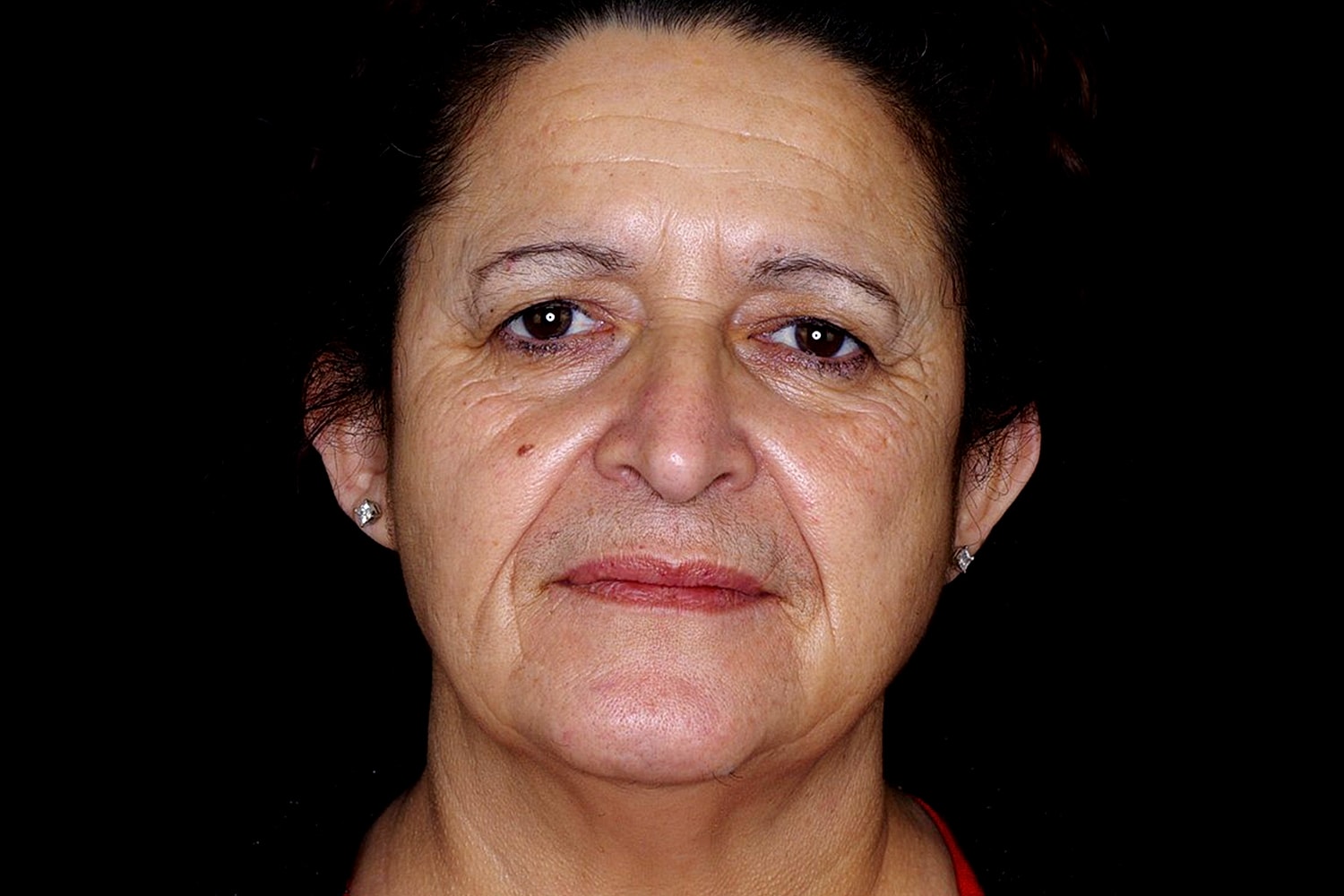 Blepharoplasty | Eyelid Lift Before & After