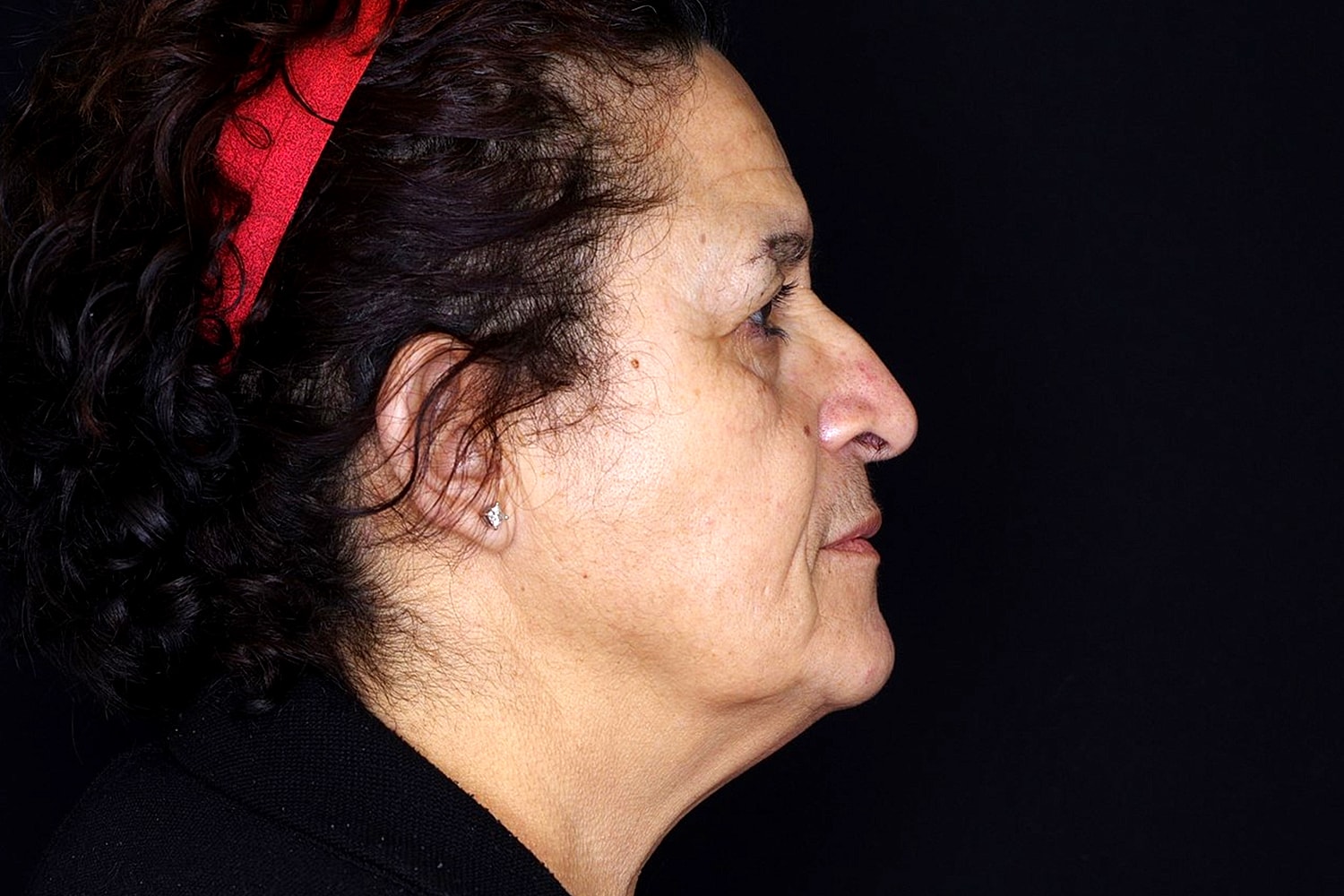 Blepharoplasty | Eyelid Lift Before & After