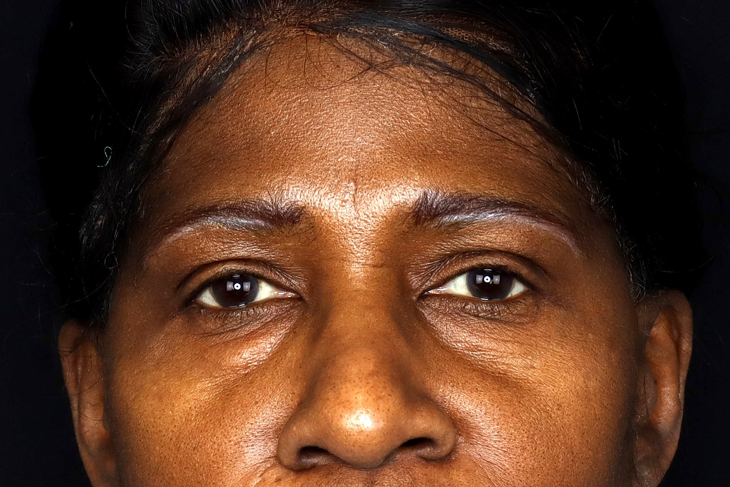Blepharoplasty | Eyelid Lift Before & After