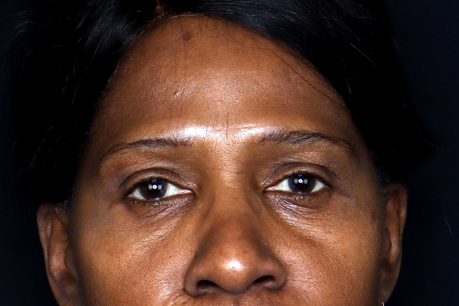 Blepharoplasty | Eyelid Lift Before & After